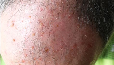 Common Skin Conditions For People Over 70