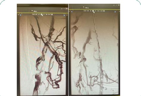 Venography Before Angiojet Left Picture Shows Intraluminal Thrombosis Download Scientific