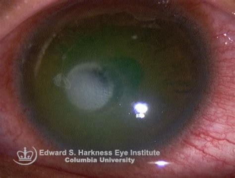 Acanthamoeba Keratitis Vagelos College Of Physicians And Surgeons