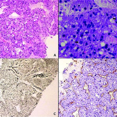 Histopathology Of Hcc With Peliotic Change A Trabecular Pattern With