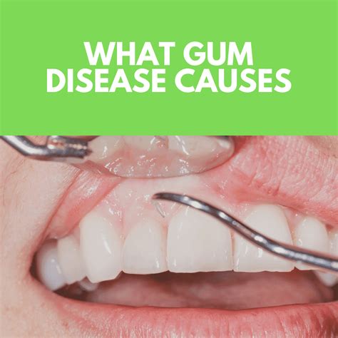 What Gum Disease Causes - Laurich Dentistry