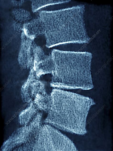 Vertebral Osteoarthritis X Ray Stock Image C0213887 Science