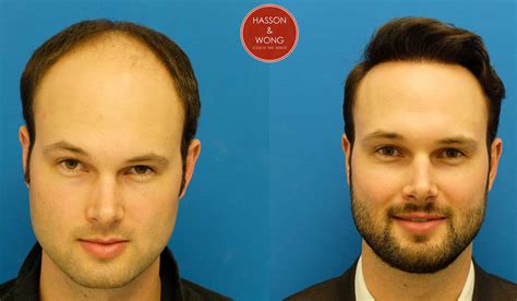 Hair Transplant Cost How Much Does Surgery Cost Per Graft