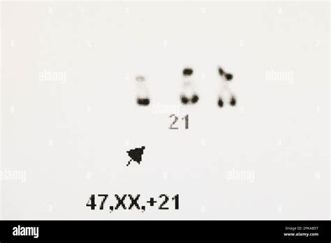 Laboratorio De Citogen Tica Detalle De Un Cariotipo Que Muestra La