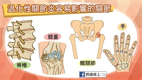 僵硬、疼痛，退化性關節炎怎麼辦？（懶人包） 照護線上