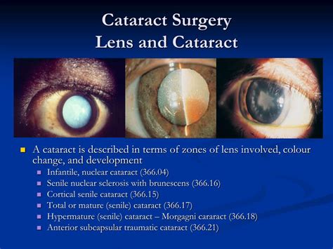 Ppt Cataract Surgery Powerpoint Presentation Free Download Id4867582