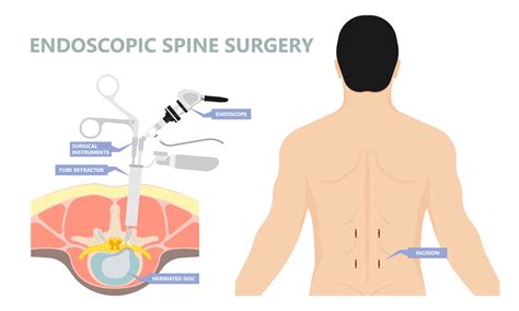 Microdiscectomy Vs Laminectomy