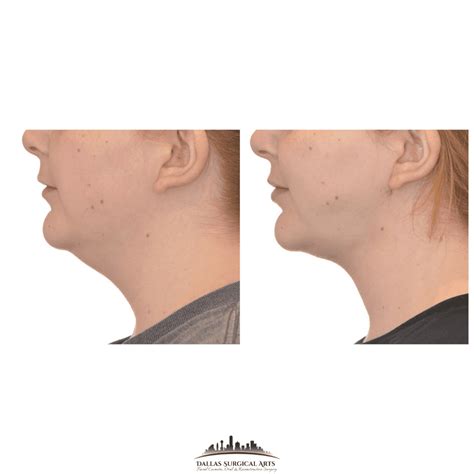 Neck Lipo