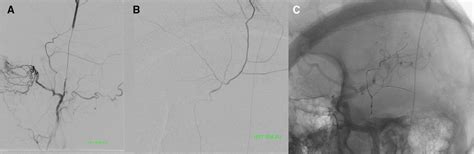 Novel Superficial Temporal Artery Access Route For Middle Meningeal