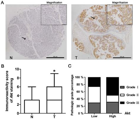 Akt Is Overexpressed In Pancreatic Cancer And Correlated To Tumor