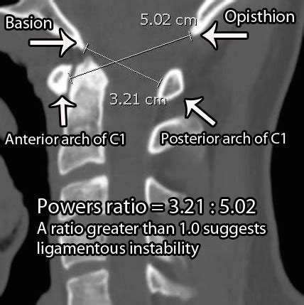 Occipital Condyle Fractures - Spine - Orthobullets