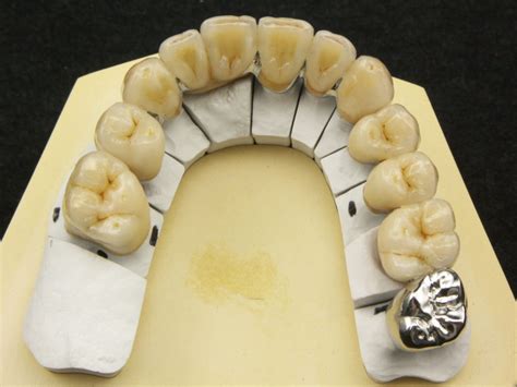 C Ramo M Tal Dental Art Technology Couronne C Ramo M Tallique Ccm