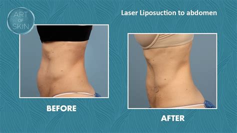 Laser Liposuction Fat Removal And Skin Tightening On Abdomen San Diego Youtube