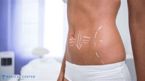 Tummy Tuck Cost In Turkey Medical Center Turkey