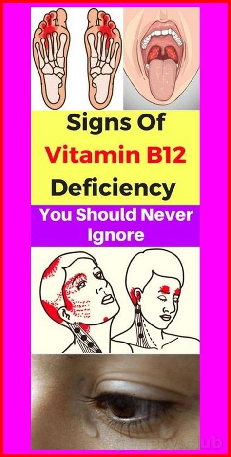 5 Warning Signs Of Vitamin B12 Deficiency You Should Never Ignore Artofit