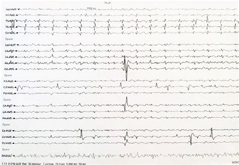 Scielo Brasil A Rare Case Of Sporadic Creutzfeldt Jakob Disease At