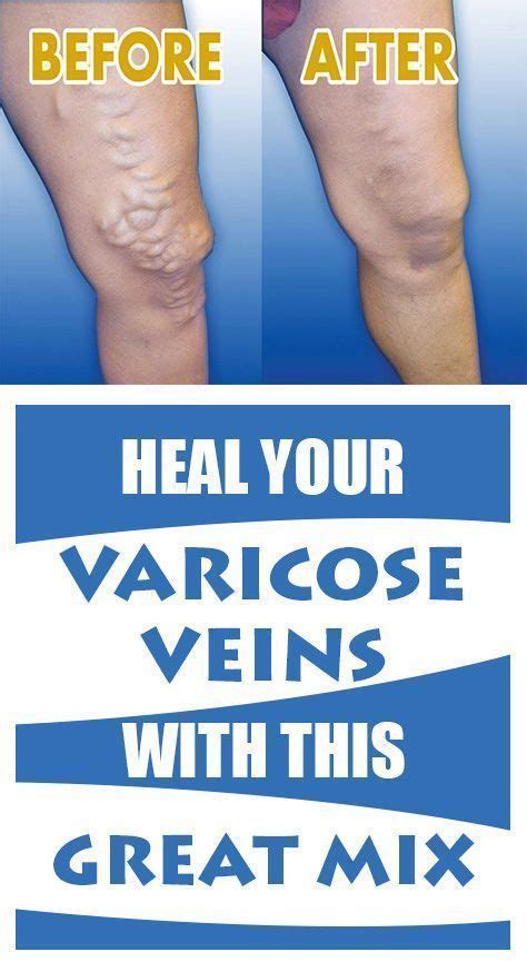 Heal Your Varicose Veins With This Great Mix