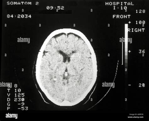 Tomografía computarizada del cerebro y el cráneo normal Fotografía de