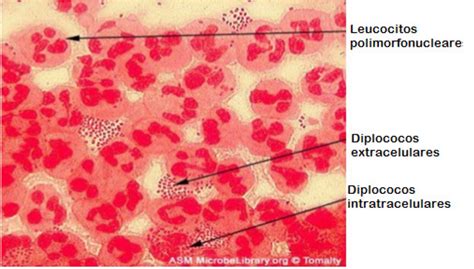 Neisseria Gonorrhoeae En Citolog A