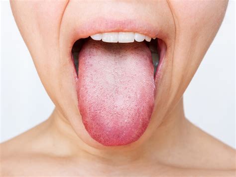 What Causes White Patches On Your Tongue