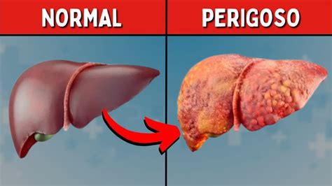 Perigoso Gordura No F Gado Quais Os Sintomas E Como Eliminar Youtube