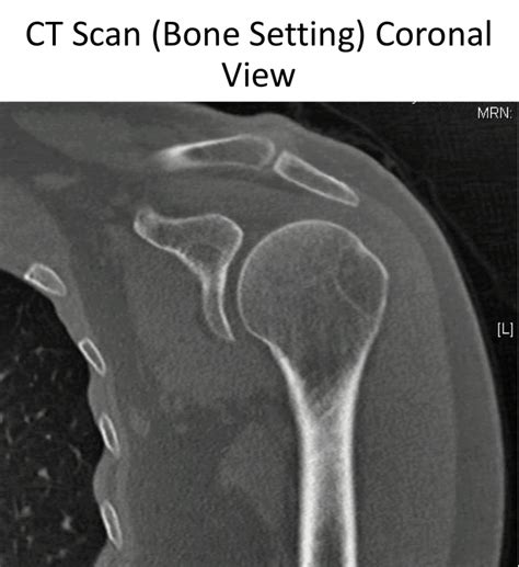 Fig 11 CT Coronal Cambridge Shoulder