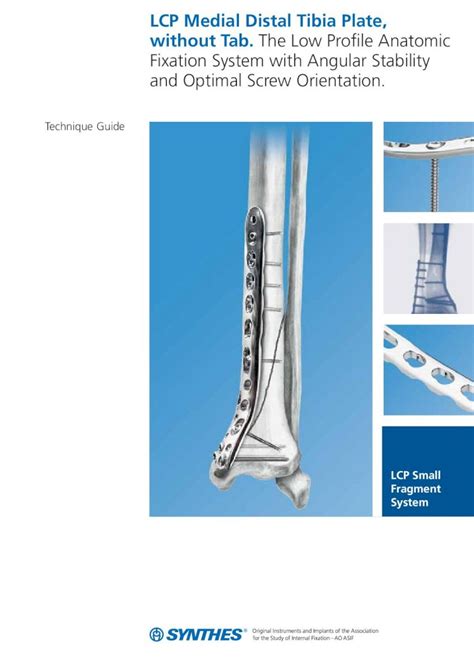 Pdf Lcp Medial Distal Tibia Plate Without Tab The Low Profile