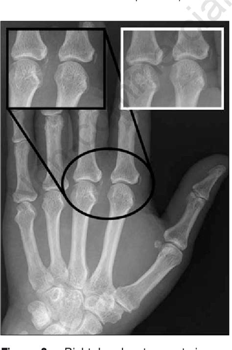 Figure From Acute Calcific Tendonitis Of Dorsal Interosseous Muscles