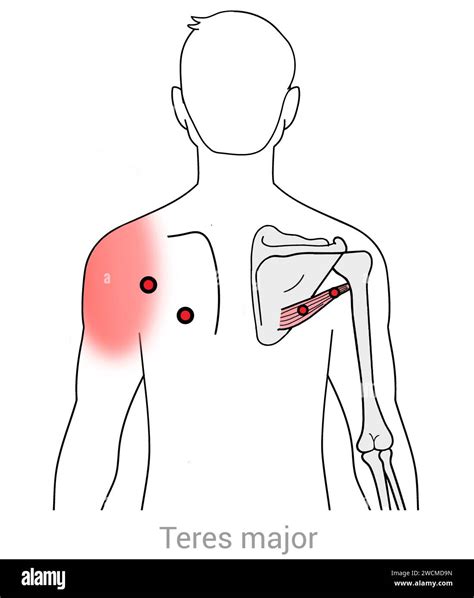 Teres Major Myofascial Trigger Points And Associated Pain Locations