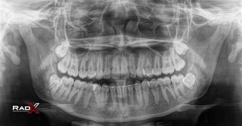 Qual é o Preço de uma Radiografia Panorâmica Guia Completo