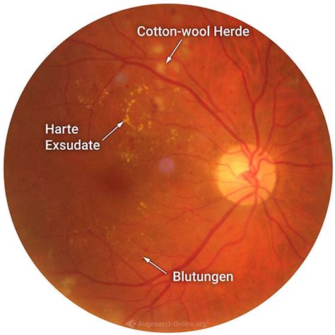 Diabetische Retinopathie Netzhaut Fundus Trainer