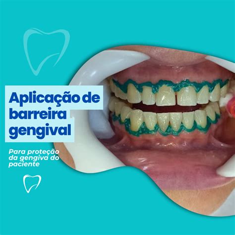 As Etapas Do Procedimento De Clareamento Dental Um Guia Completo Para