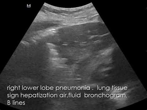 CASE 744 Lung Ultrasound Pneumonia Lung Tissue Sign Hepatization Air