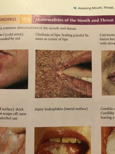 Health Assessment Ch 18 Mouth Throat Nose Sinuses Flashcards Quizlet