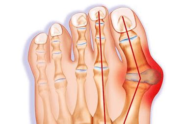 Bunion And Hammer Toe Surgery In Singapore