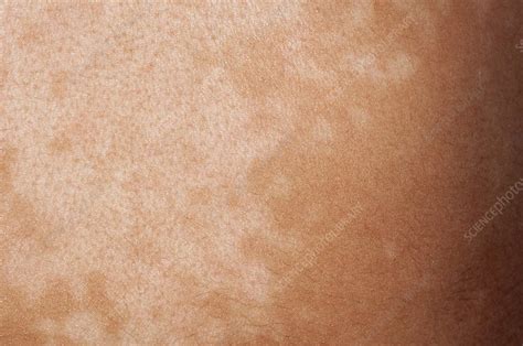 Pityriasis Versicolor Skin Infection Stock Image C