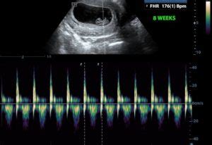 Baby’s Heart-Beat – Does it Really Tell you the Baby’s Gender ...