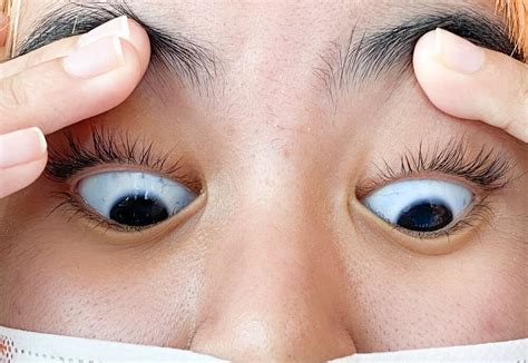 Blue Sclera Causes Risks And Functions Of The Sclera