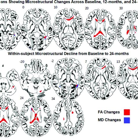 Whole Brain Voxel Wise Analysis Of Callosal Changes Across 24 Months A