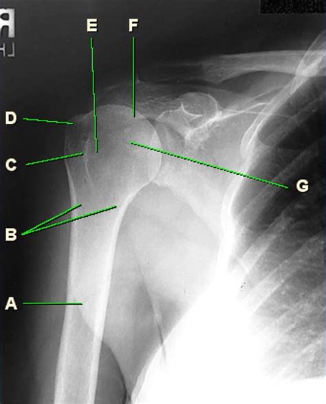 Ap External Rotation Shoulder Diagram Quizlet