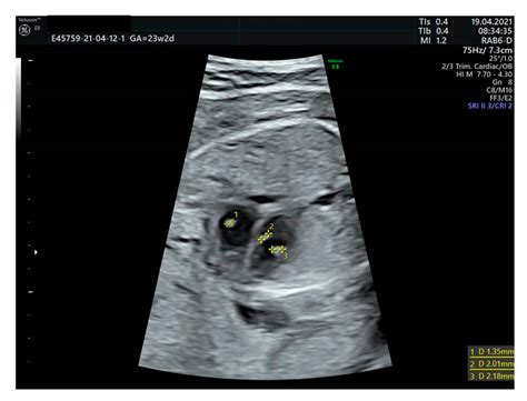 Reprod Med Free Full Text Role Of Sonographic Second Trimester