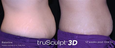 Trusculpt 3d Toronto Scarborough Laser Surgery Body Sculpting