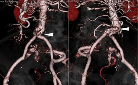 Transapical Thoracic Endovascular Aortic Repair In Aortic Arch Aneurysm