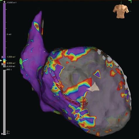 Electroanatomical Map Of The Left Ventricle In Anteroposterior View