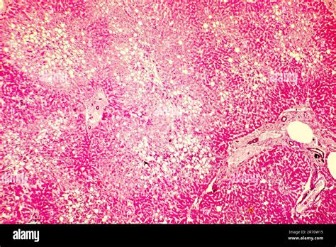 H Gado Graso Esteatosis Hep Tica Fotomicrograf A Que Muestra Grandes