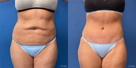 Abdominoplasty Before And After Gallery