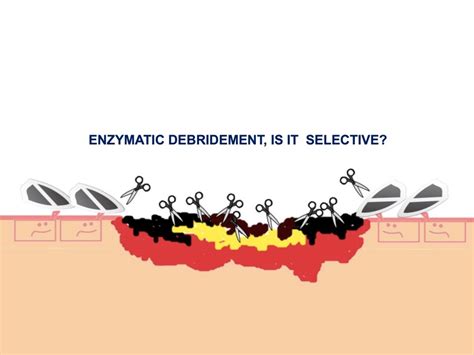 Enzymatic Wound Debridement Market To Expand At A Cagr Of 7by 2032
