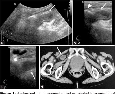 Figure 1 From Small Bowel Obstruction Secondary To Obturator Hernia