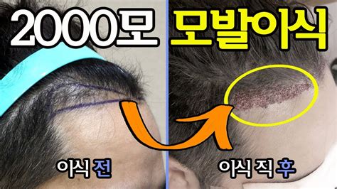 비절개모발이식 남성 헤어라인교정 무삭발 모발이식 리얼후기 전후사진 동영상 Youtube