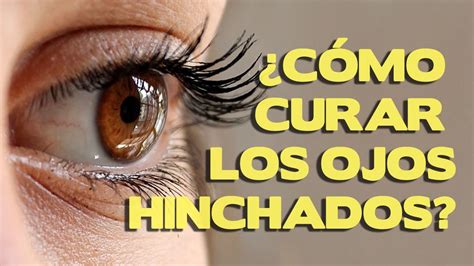 Como Curar Los Ojos Hinchados Metodos Para Quitar La Hinchazon Youtube